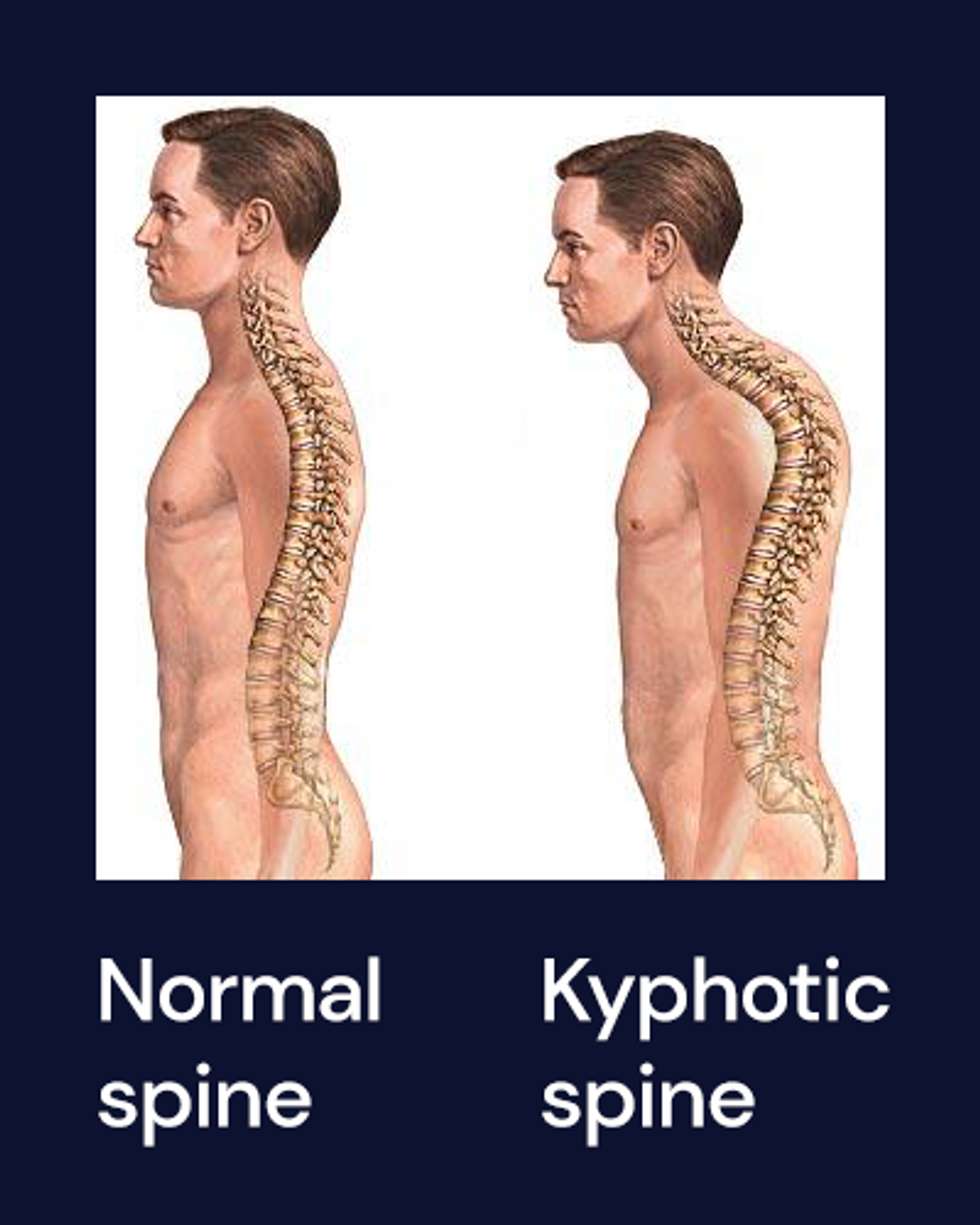 A depiction of a kyphotic spine compared to a healthy one